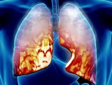 Πνευμονία: Τι πρέπει να προσέχεις στο «αθώο» κρυολόγημα – Ποια συμπτώματα πρέπει να σας ανησυχήσουν